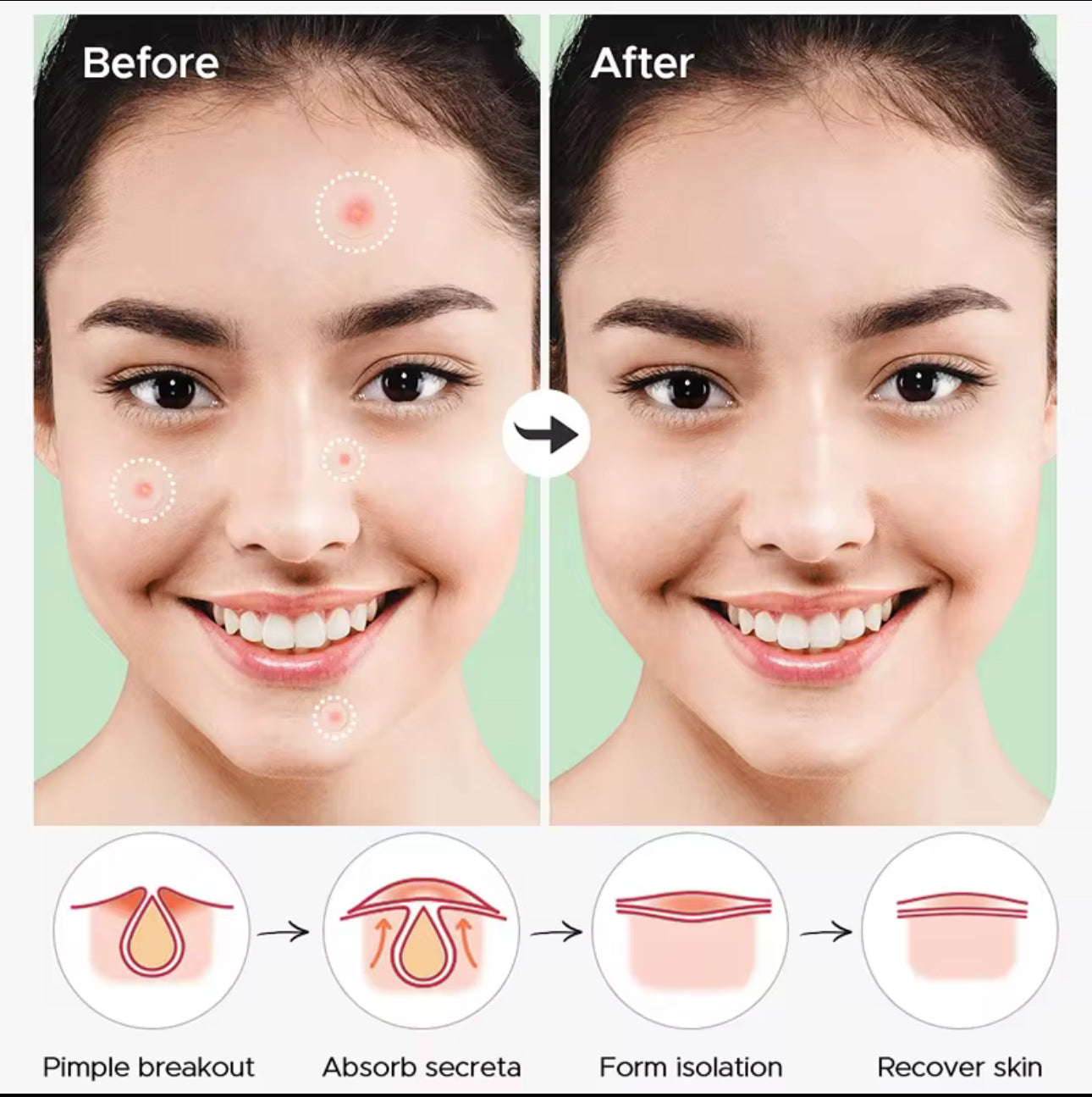 Invisible Acne Patch with Essential Oil – Soothing & Concealing for Clear Skin